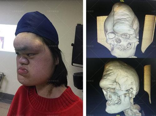 颅骨突出是什么原因(额头颅骨突出)-第1张图片-