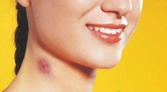 如何消除吻痕（小方法快速去吻痕）