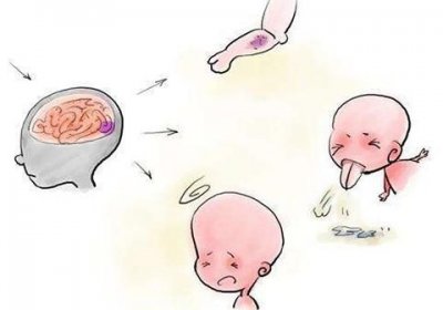 ​脑膜炎症状及表现(脑膜炎症状及治疗方法)